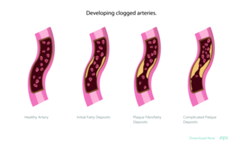 Clogged Arteries Formation — Heart Disease Vector Illustration
