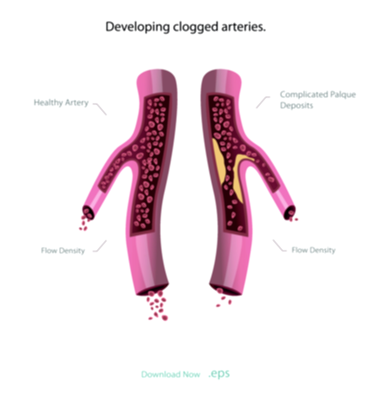 Blood Vessel Blockage — Cardiovascular System Vector Illustration