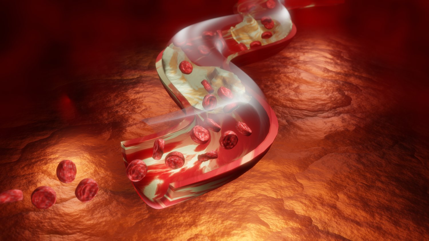 Artery Obstruction — Heart and Blood Flow jpg image