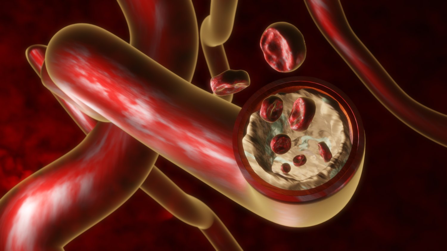 Arterial Blockage — Blood Circulation jpg image