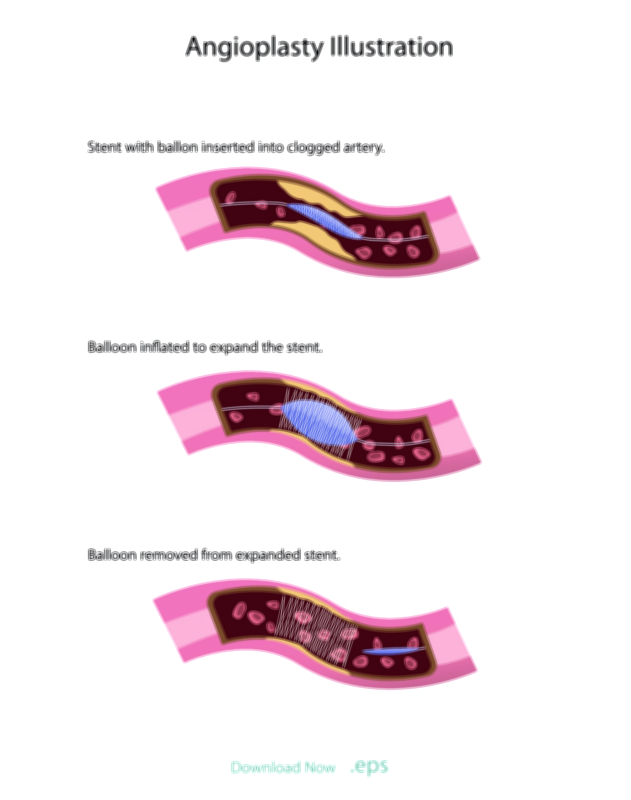 Stent in Heart Arteries — Cardiovascular Treatment Vector Illustration