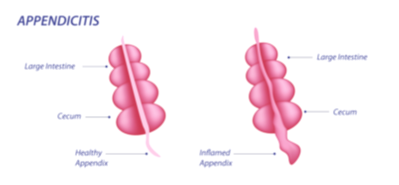 Appendicitis — Inflammation of Appendix Vector Illustration