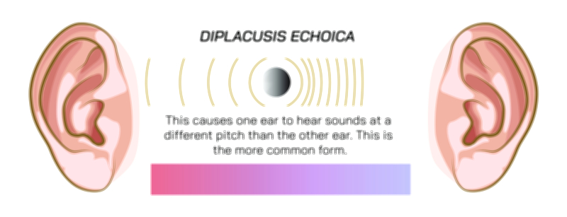 Diplacusis Echoica — Auditory Delay Perception Disorder Vector Illustration