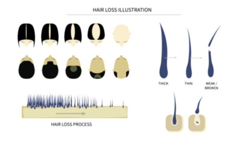 Hair Loss Stages Vector Illustration | Baldness Progression and Follicle Degeneration Explained