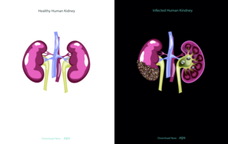 Human kidney issues and diseases vector illustration
