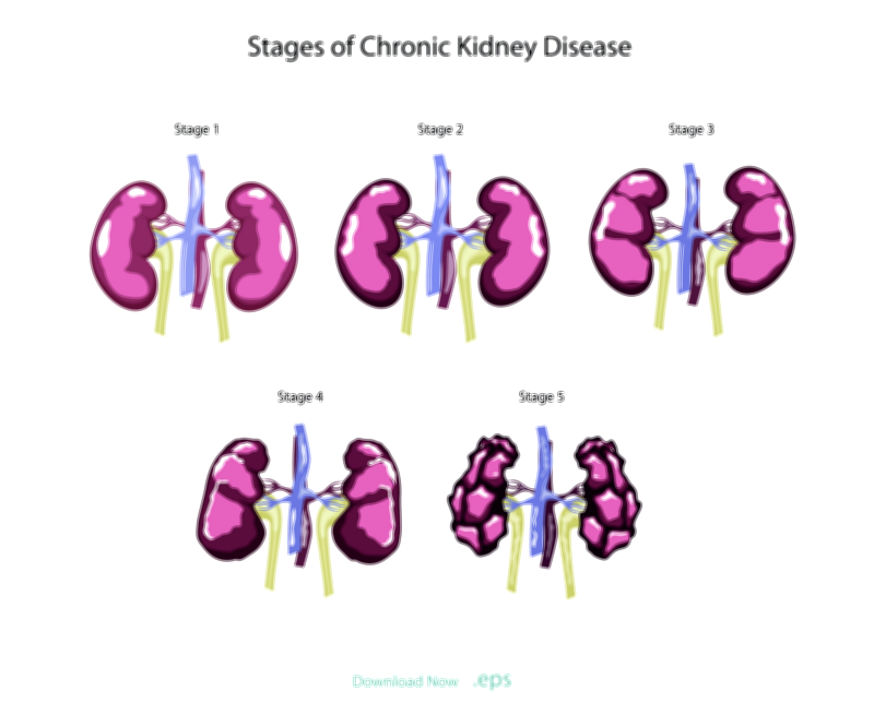 Stages of chronic kidney disease vector illustration