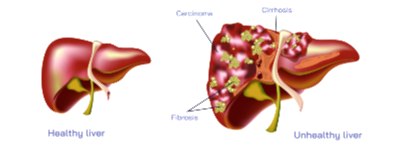 Human Liver Disease Vector Illustration – Types, Symptoms, and Stages of Liver Damage Explained