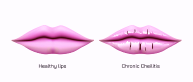 Healthy Lips vs Cheilitis Lips Inflammation Comparison Vector Illustration