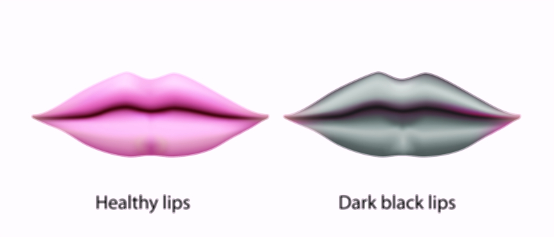 Healthy Lips vs Dark Lips Pigmentation and Care Vector Illustration