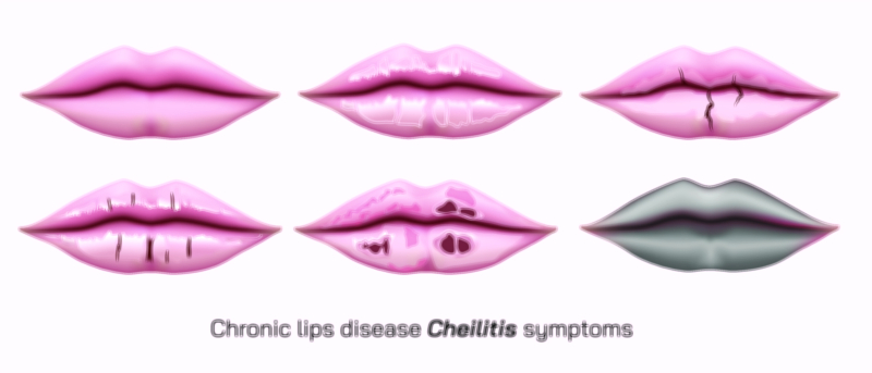 Chronic Lips Diseases Symptoms and Treatment Awareness Vector Illustration