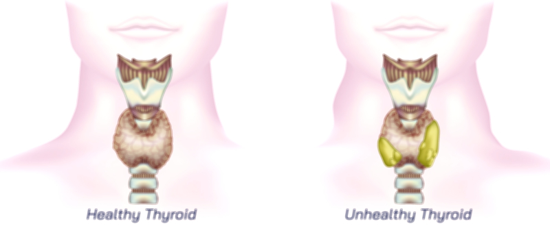 Healthy and Unhealthy Thyroid anatomy medical vector illustration for endocrine system and health education