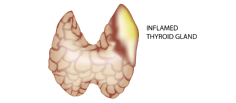 Inflamed Thyroid medical vector illustration for endocrine health and disease education