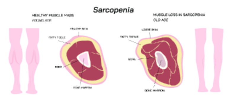 Sarcopenia Muscle Loss, Causes, and Prevention Methods | Medical Health Vector Illustration