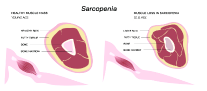 Sarcopenia Muscle Degeneration, Causes, and Prevention | Human Health Vector Illustration