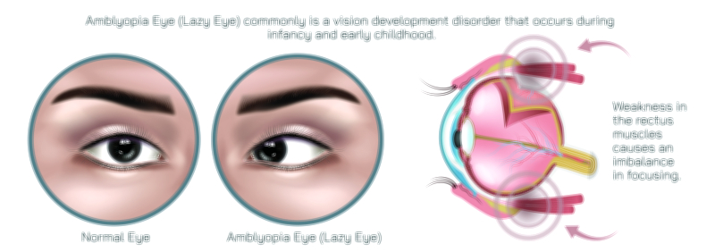 Amblyopia eye disease vector illustration for medical and vision health education