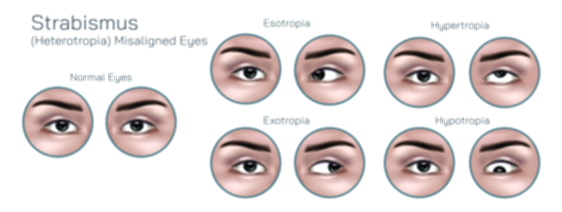Strabismus Vector Illustration for Eye Disease Showing Misaligned Eyes, Symptoms, and Corrective Treatment