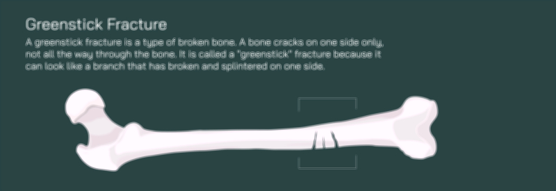 Greenstick Fracture Vector Illustration of Femur Bone Showing Partial Crack and Pediatric Bone Injury