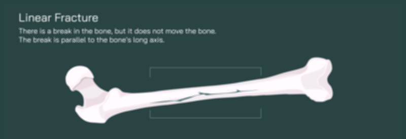 Linear Fracture Vector Illustration of Femur Bone Showing Straight Crack and Orthopedic Healing Process