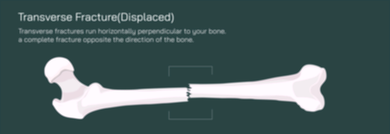 Transverse Fracture Vector Illustration of Displaced Bone Showing Horizontal Break and Orthopedic Realignment Process
