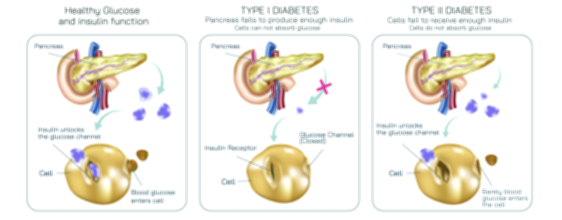 Diabetes Type One and Type Two Vector Illustration Showing Insulin Deficiency, Blood Sugar Levels, and Pancreas Function