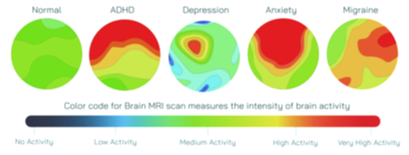 Brain MRI Color Codes Vector Illustration Showing Normal, ADHD, Anxiety, Depression, and Migraine Patterns in Human Brain