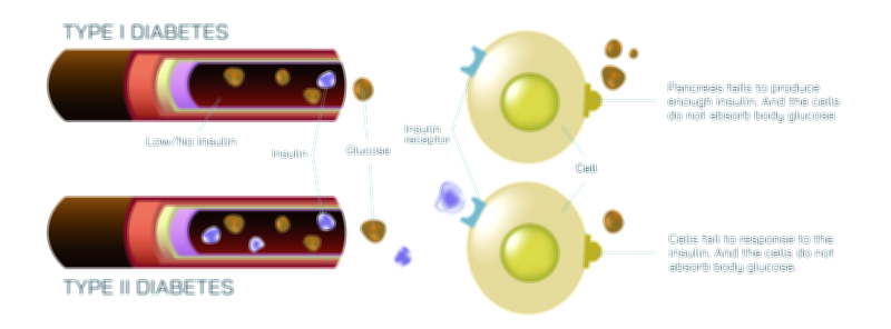 Diabetes Type One and Type Two Vector Illustration Showing Blood Sugar Levels, Insulin Function, and Glucose Regulation