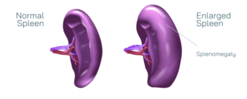 Enlarged Spleen Vector Illustration Showing Spleen Anatomy, Causes, and Effects on Blood Filtration