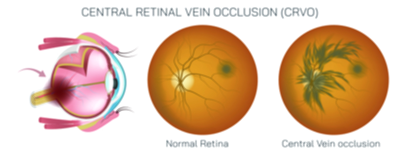 Central Retinal Vein Occlusion (CRVO) Eye Disease Vector Illustration Showing Retinal Blockage and Vision Loss