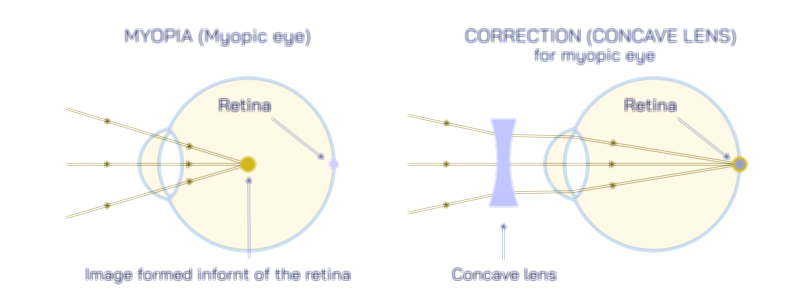 Myopia Eye and Concave Lens Vector Illustration Showing Nearsighted Vision Correction