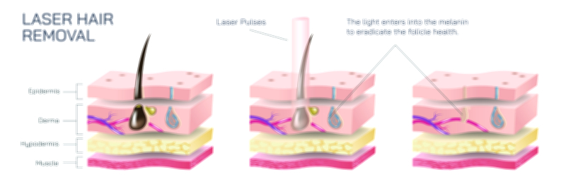 Laser hair removal vector illustration showing skin layers, laser beam targeting hair follicles, and permanent hair reduction process