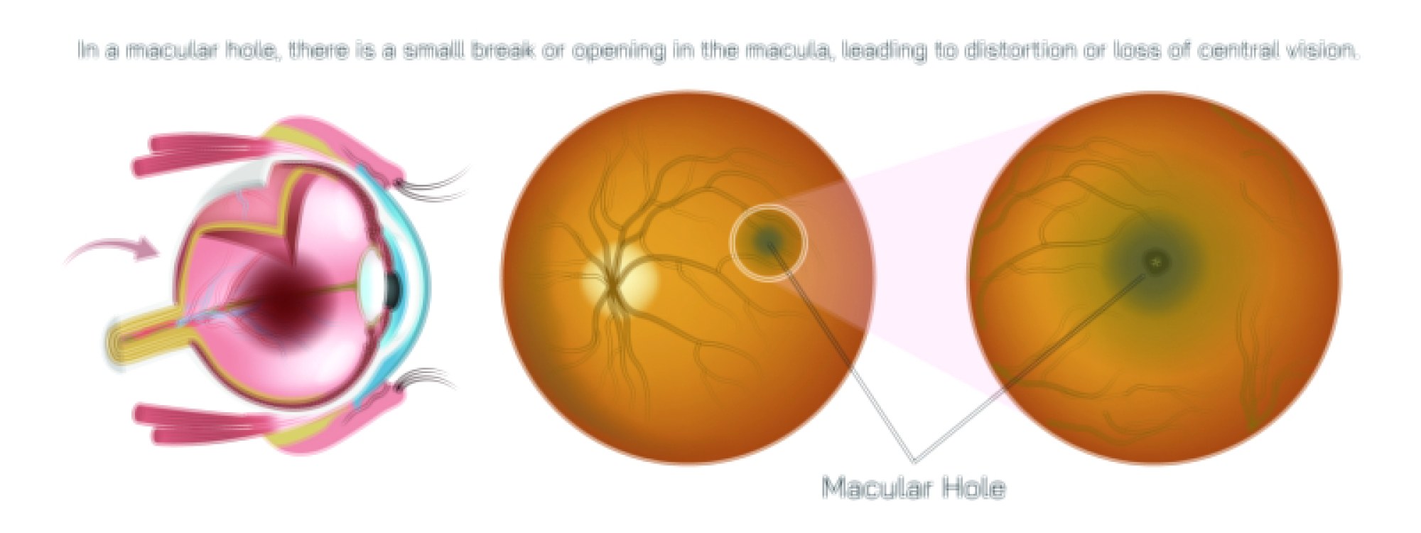 Macular hole vector illustration showing retinal layers, fovea damage, and central vision loss in human eye anatomy