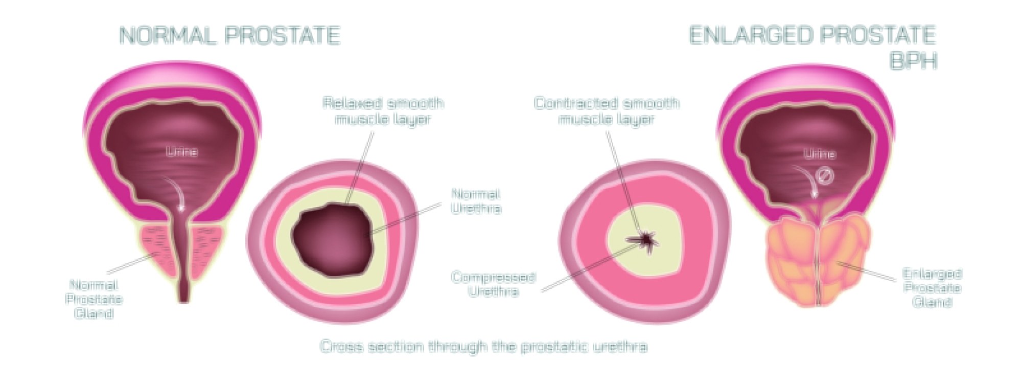 Normal Prostate vs Enlarged Prostate: Medical Comparison of Structure, Symptoms, and Urinary Effects