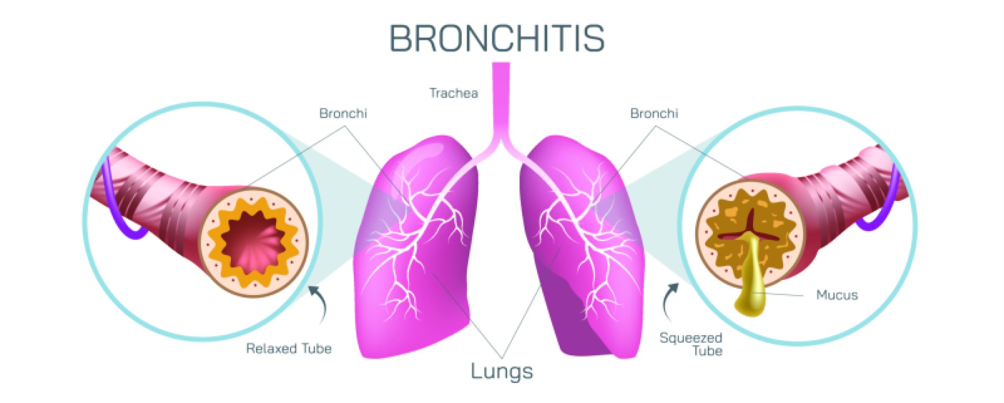 Bronchitis Illustration: Inflammation of Bronchi and Respiratory Tract Explained