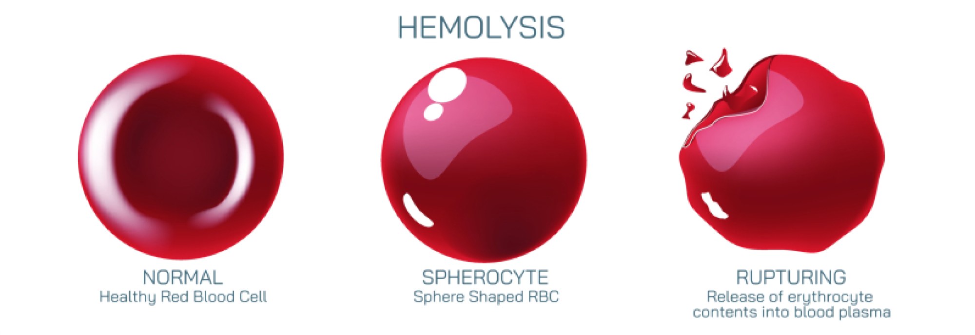 Hemolysis Illustration: Breakdown of Red Blood Cells and Release of Hemoglobin