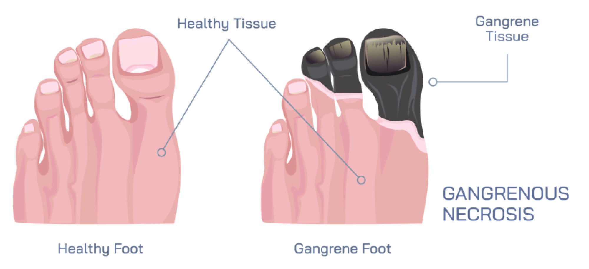 Gangrenous Necrosis and Gangrene Illustration: Tissue Death and Infection Explained