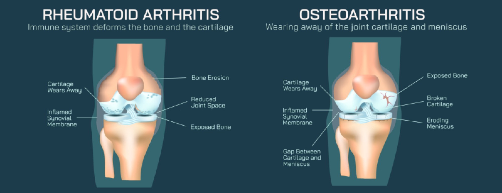 Osteoarthritis vs Rheumatoid Arthritis Illustration: Joint Damage and Inflammation Differences Explained