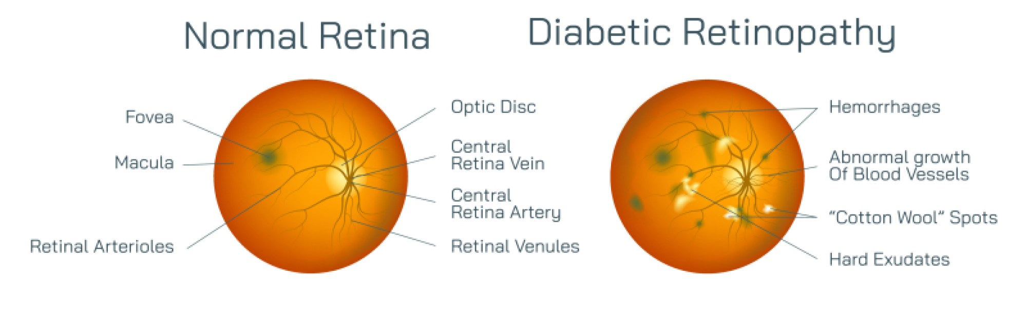 Normal Retina and Diabetic Retinopathy Understanding Visual Tissue Health