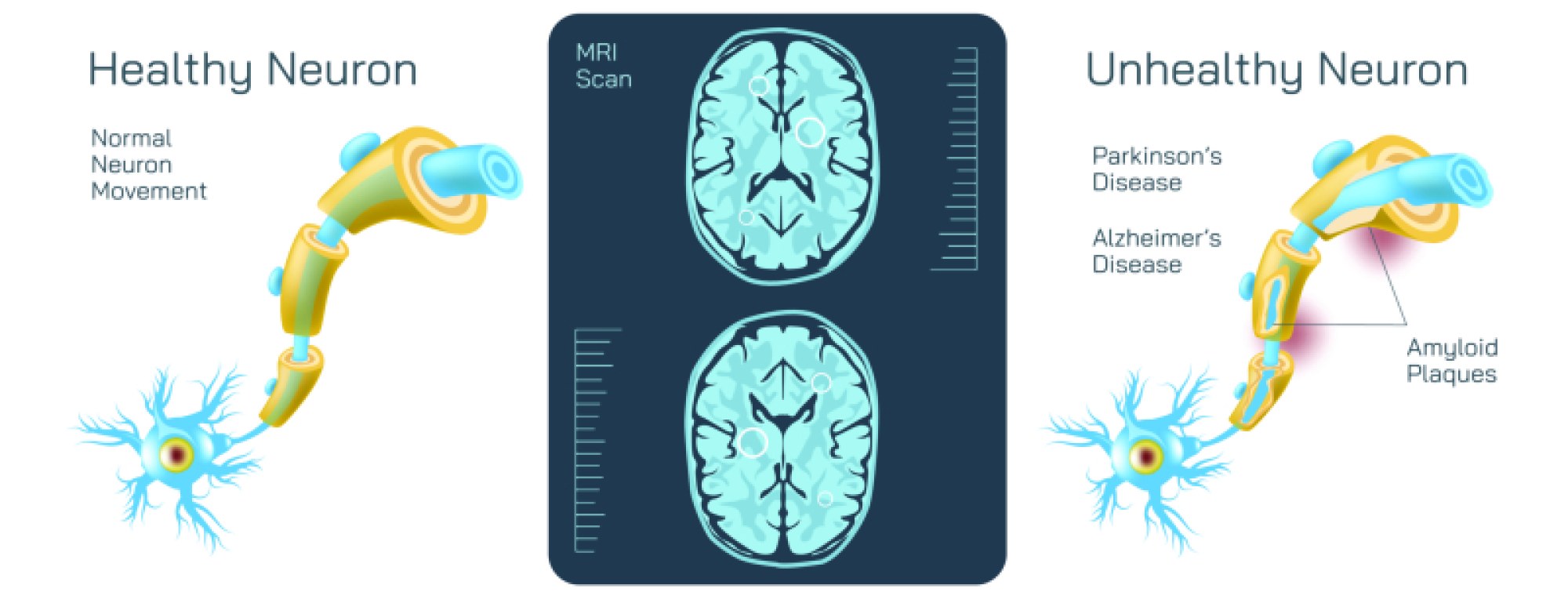Healthy vs Unhealthy Neurons — Structure, Function, and Common Disorders