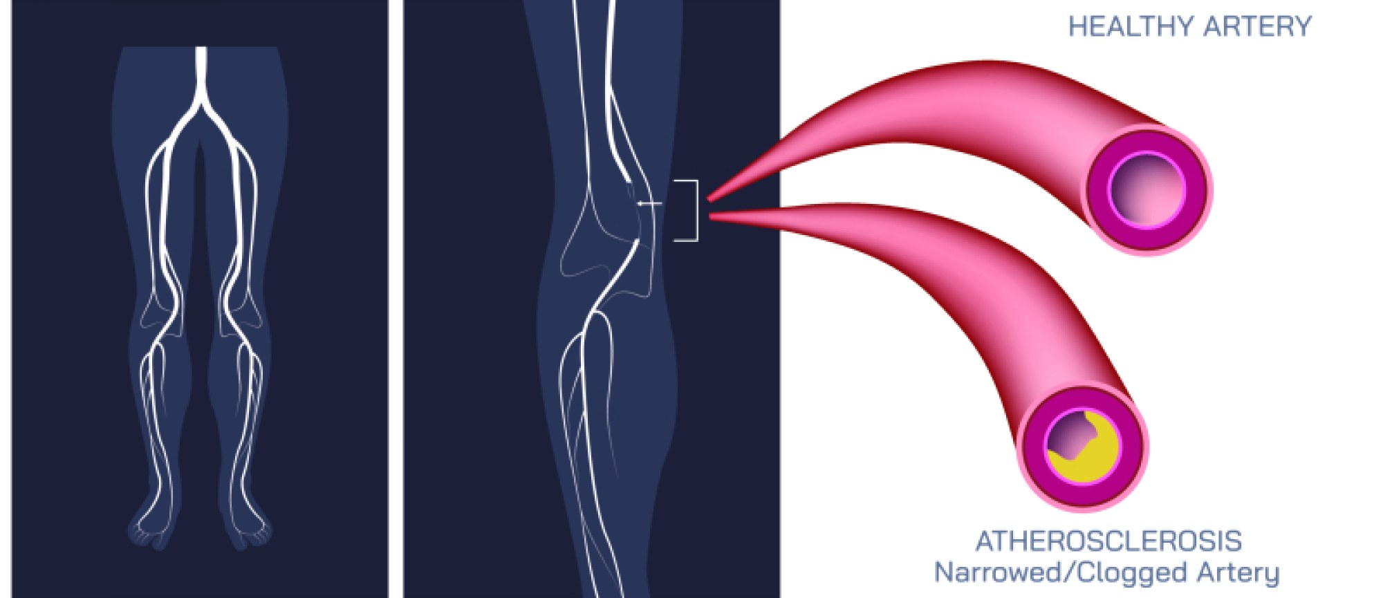 Leg Arteries Clogged — Causes, Symptoms, and Treatment Options