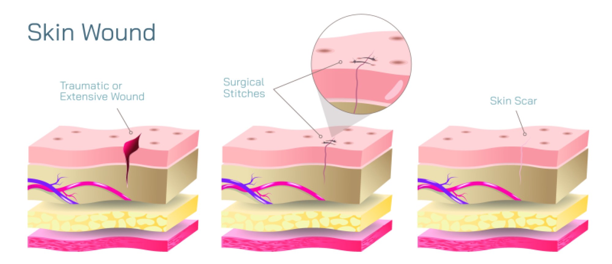 Skin Wound Vector — Anatomy, Types, and Visual Illustration