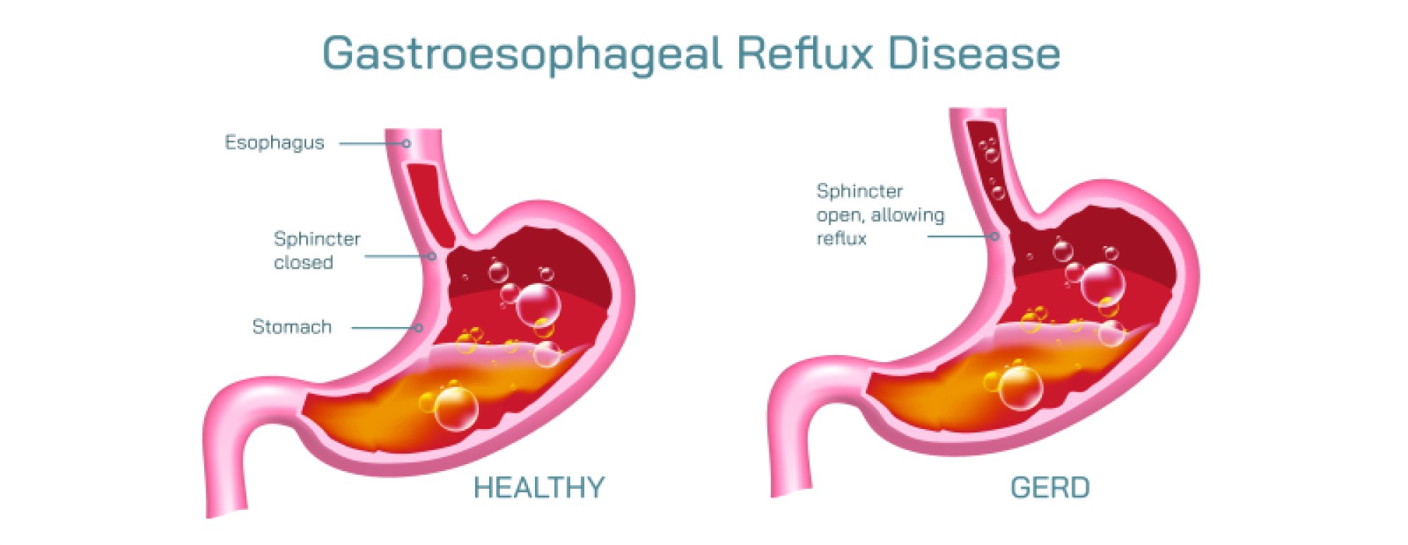 Stomach GERD — Causes, Symptoms, and Management of Acid Reflux