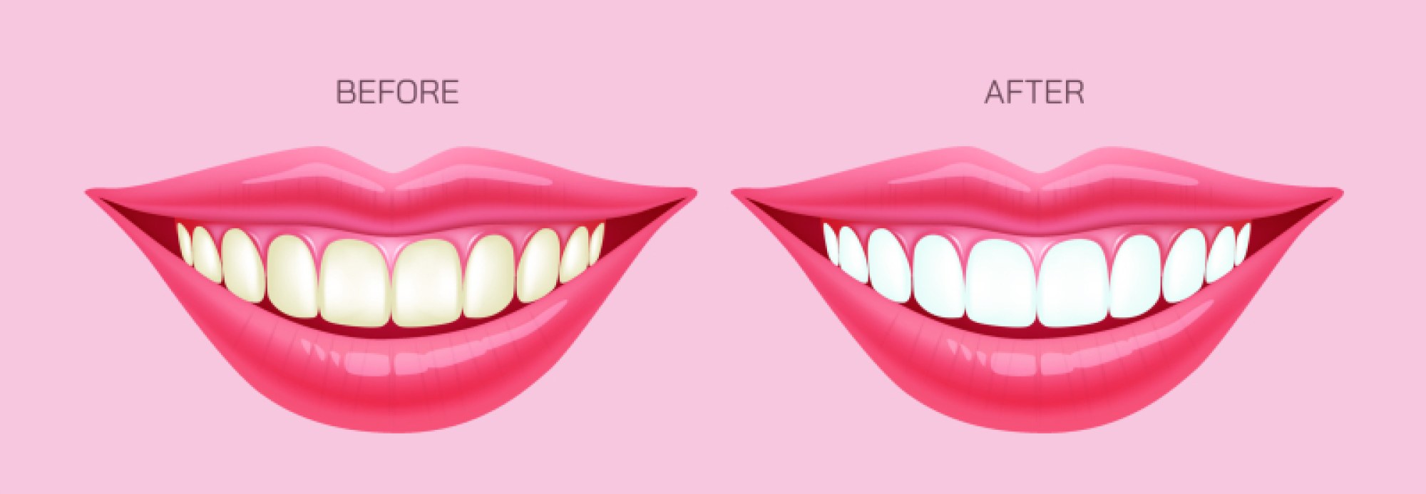 Teeth Whitening Before and After Vector Illustration: Editable Design for Dental Clinics, Cosmetic Dentistry, and Oral Health Projects