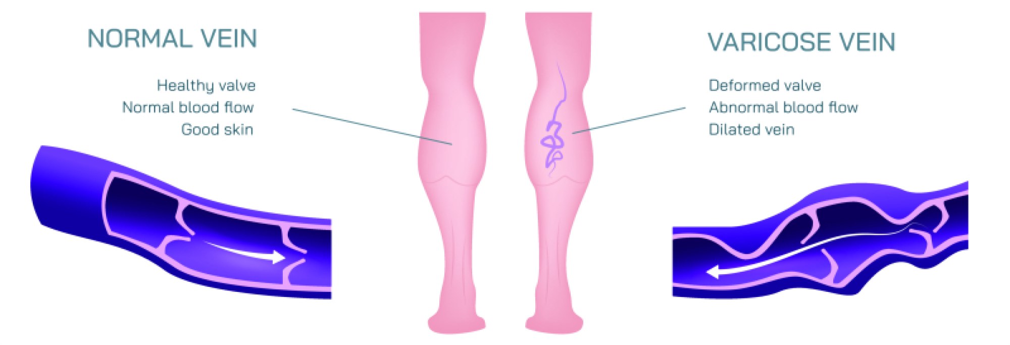 Detailed Vector Illustration Depicting Varicose Veins in Human Calves with Clear Anatomical Visualization and Circulatory Structure Insight