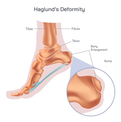 Haglund’s Deformity Explained: Causes, Symptoms, Diagnosis, Treatment and Prevention of Heel Bone Enlargement
