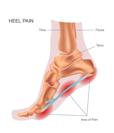 Heel Pain Explained: Phalanges Overload and Plantar Fasciitis Causes, Symptoms, Treatment and Long-Term Recovery Strategies