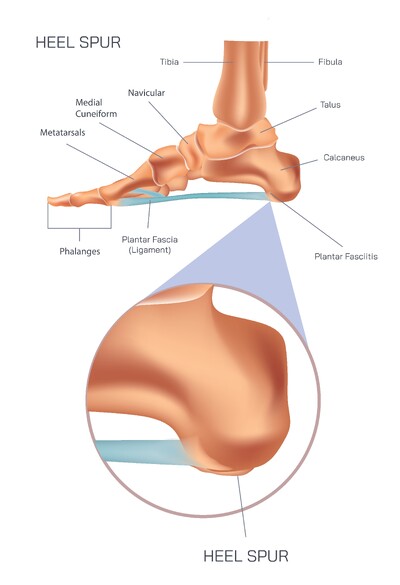 Heel Spur Explained: Causes, Symptoms, Diagnosis, Treatment and Prevention for Sharp Heel Pain and Long-Term Foot Relief