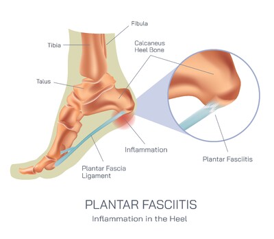 Plantar Fasciitis Inflammation in the Heel: Causes, Symptoms, Diagnosis, Treatment and Recovery for Chronic Heel Pain