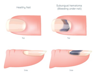 Subungual Hematoma Explained: Causes, Symptoms, Treatment, Nail Bleeding Relief and Recovery After Injury or Trauma