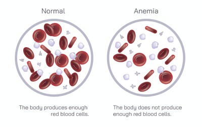 Anemia Explained: Causes, Symptoms, Diagnosis, Treatment and Prevention of Low Hemoglobin and Reduced Red Blood Cell Count