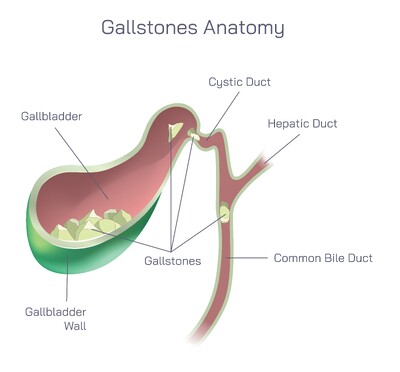 Gallstones Anatomy Explained: How Gallstones Form, Their Causes, and Impact on the Digestive System